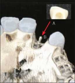 Figure 6-7. Tube-shaped prosthetic teeth are modified acrylic resin or porcelain teeth with a canal prepared in their basal region (A). A pin-shaped extension is incorporated into the metal framework to provide retention within the tube tooth (B).