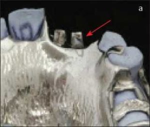 Figure 6-8a. Santral ve lateral diş için metal alt yapıda oluşturulan güçlendirilmiş gövde