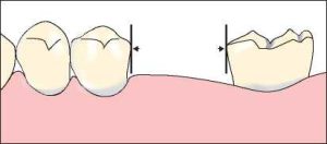 Figure 7-11. a) Guide plane surfaces to be shaped on the cast using the surveyor blade the dental surveyor.