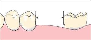Figure 7-11. b) Guiding planes prepared parallel to the path of placement of the prosthesis.