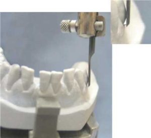 Figure 7-13. The surveyor blade creates a triangular undercut area between the abutment tooth and the gingival tissues.