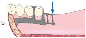 Figure 7-15. b) When a downward force is applied to the prosthesis, the lingual bar moves upward; however, the soft tissue over the ridge remains unaffected.