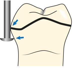 Figure 7-17. During undercut measurement on the abutment tooth, the lateral surface of the undercut gauge should contact the tooth’s height of contour, while its tip should touch the tooth surface within the undercut area.