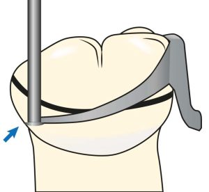 Figure 7-18. To ensure the clasp retentive tip engages the accurately measured undercut area, the point of contact of the undercut gauge is marked on the abutment tooth by drawing.