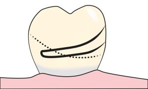 Figure 7-19. The clasp is drawn on the cast so that the clasp tip contacts the designated undercut point.