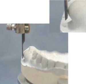 Figure 7-6. When the tuberosity is excessively prominent, the denture flange cannot be extended adequately in accordance with the path of insertion.