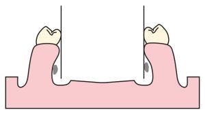 Figure 7-7. When mandibular teeth are excessively inclined lingually, it may interfere with the proper placement of the lingual bar, and therefore must be identified during cast surveying.
