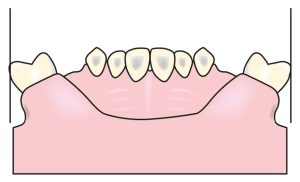 Figure 7-8. Excessive buccal inclination of the maxillary teeth may create problems in the prosthesis design.