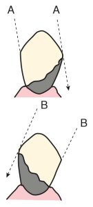 Figure 8-9. When determining the location of the direct retainer, the retention system and the axis of rotation must be taken into account. In cases where two direct retainers are used, a fulcrum axis is established; therefore, the effect of the direct retainers is enhanced by incorporating an indirect retainer.R: Retainer, IR: Indirect Retainer.