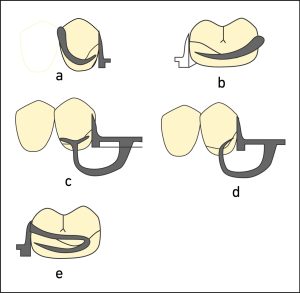 Figure 8-14. Clasp options for Class II survey line: For tooth-supported edentulous spaces, reverse circumferential Akers clasp (a) or ring clasp (b). For terminal abutments in distal extension edentulous spaces, T or Y-bar clasp (c) or modified T-bar clasp (d). For abutments in the opposing arch, hairpin clasp (e).