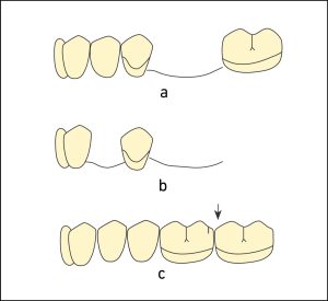 Figure 8-15. Examples of Class III survey lines according to the positions of the abutment teeth in the arch and the types of edentulous spaces; a) abutment adjacent to the edentulous space, b) single or distal extension abutment, c) opposing arch abutments.