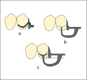 Figure 8-16. Clasp options for Class III survey line: Wrought wire clasp (a), I-bar clasp (b), or Y-bar clasp (c) on the terminal abutment in distal extension edentulous spaces.