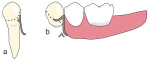 Figure 8-20. When a bar clasp is used in the presence of a close frenulum attachment, the clasp arm is aligned with the vertical slope of the acrylic base, applying either option (a) or (b) according to the existing undercut area on the tooth.