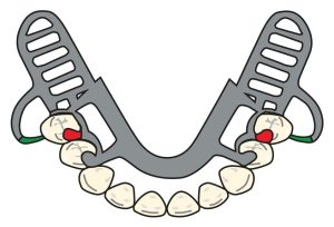 Figure 8-23. Use of bar clasp in Cl I prostheses when a distobuccal undercut is present.