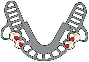 Figure 8-25b. Clasps are not used in modification spaces in Cl I prostheses.