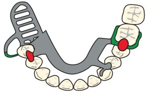 Figure 8-26. Cl II prostheses: flexible clasp design on the free-end side and rigid clasp design on the opposing side.