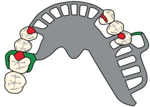 Figure 8-28. No additional clasps are used on abutment teeth surrounding anterior modification spaces in Cl II prostheses.