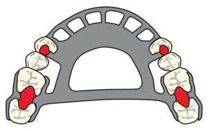 Figure 8-3. Occlusal rests placed on abutment teeth adjacent to the edentulous space and on the most posterior abutment teeth.