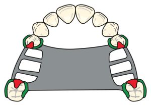 Figure 8-30. Use of four clasps in the presence of a modification space in Class III prostheses.