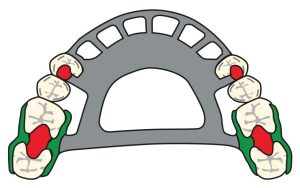 Figure 8-31. Use of double Akers clasps on the most posterior abutment teeth in Cl IV prostheses. The decision to use clasps on anterior abutments depends on the length of the edentulous area and the patient’s esthetic preference.