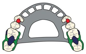 Figure 8-39. Embrasure rests used between molar teeth on both sides and Akers clasps placed on the mesiobuccal undercuts of the first molars on both sides act as indirect retainers.