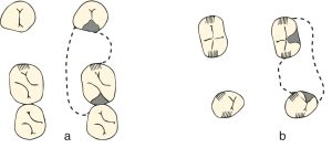 Figure 8-4.a) Due to occlusal contact on the mesial proximal surface of the first molar with the opposing tooth, the occlusal rest is placed on the distal surface of the same abutment tooth. b) Since occlusal contacts exist on both the mesial and distal surfaces of the abutment teeth, the occlusal rests are positioned on the lingual surfaces of the abutment teeth.