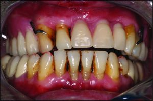 Figure 9-10. In maxillary bilateral distal extension prostheses, during right lateral movement, opposing posterior tooth contacts on the non-working side help stabilize the maxillary denture.