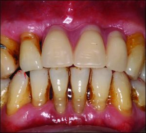Figure 9-11. a) In Class IV prostheses, slight contact in centric occlusion prevents overeruption of opposing natural teeth.