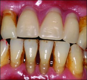 Figure 9-11. b) In eccentric movements, care is taken to avoid contact with the antagonist teeth.