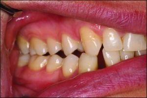 Figure 9-2. In unilateral balanced occlusion, nearly all teeth on the working side contact through their buccal cusps.