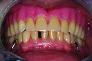Figure 9-3. Simultaneous bilateral contacts of opposing posteriorteeth in bilateral balanced occlusion.