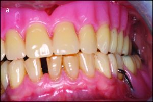 Figure 9-4. In bilateral balanced occlusion during left lateral movement:a) Antagonist tooth contacts on the working side occur through the buccal cusps.