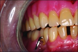 Figure 9-4. In bilateral balanced occlusion during left lateral movement: b) On the non-working side, antagonist contacts occur between the palatal cusps of the maxillary teeth and the buccal cusps of the mandibular teeth.
