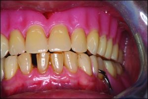 Figure 9-5. In bilateral balanced occlusion during protrusive movement, antagonist contacts occur in the anterior incisor region and between the second molars on both sides posteriorly, creating a three-point contact.