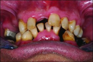 Figure 9-6. In a patient who has been edentulous for a long time, positional changes in the natural teeth lead to occlusal discrepancies.