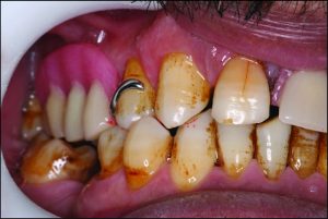 Figure 9-8. The arrangement of the occlusion in tooth-supported removable partial dentures can resemble that of a harmonious natural dentition.