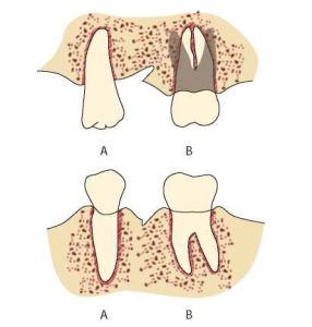 Figure 1-27. Crown-root morphology.(A) As the roots of teeth exhibit a cylindrical or increasingly narrow structure, their resistance to forces weakens. (B) As the surface area of ​​the root within the bone increases, its support potential increases.
