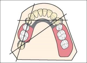 Figure 1-38. The triangular clasp design is the most ideal clasp configuration in Class II cases with modification spaces.
