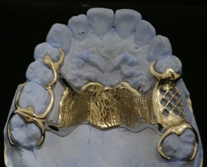 Figure 5-3. In Class III cases, a palatal strap may be used to provide support from the opposing arch; however, its width should not be less than 8 mm.