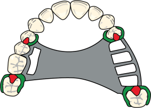 Figure 8-29b. Cl III denture clasp designs for the maxilla.