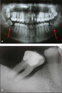 Şekil 10-1. Meziale devrilmiş, prognozu şüpheli ve protez planlamasını zorlaştıracak olan molar dişlerin a) panoramik b) periapikal radyografik görünümleri.