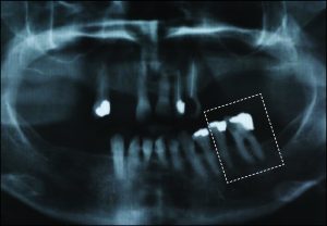 Şekil 10-14. Periodontal desteğinin yarısını kaybetmiş bir terminal destek dişin sabit olarak splintlenmesi komşu dişin sağlığı iyi durumda olsa bile uygun değildir.