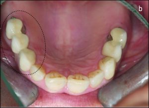 Şekil 10-15. (b) periodontal desteğin arttırması.