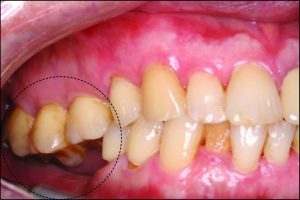 Şekil 10-16. Maksiller posterior bölgede, dişlerdeki uzamanın tüberin sarkıklığı ile birlikte görülmesi, interark mesafesini daraltır ve protezin yapımını güçleştirir.