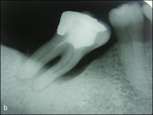 Şekil 10-1 b) periapikal radyografik görünüm.