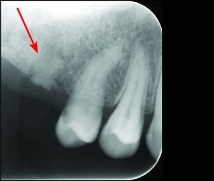 Şekil 10-2. Yüzeye yakın ve patolojik görüntü veren kök artığının radyografik görünümü.