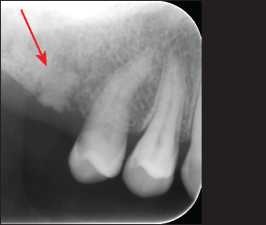 Şekil 10-2.Yüzeye yakın ve patolojik görüntü veren kök artığı-nın radyografik görünümü.