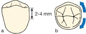 Şekil 10-21. a) Diş destekli boşluğa komşu rehber düzlemin yüksekliği 2-4 mm’dir. b) Hazırlanan yüzey, okluzalden bakıldığında düz değildir; aproksimal yüzeyin doğal kurvatürünü taklit eder.