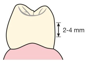 Şekil 10-24. Lingual rehber düzlemin okluzogingival yüksekliği 2-4 mm’dir ve klinik kronun orta üçlüsünde konumlanır.