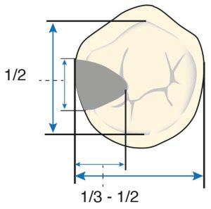 Şekil 10-32. Okluzal tırnağın boyutu, dişin tüberkül tepeleri arasındaki bukkolingual genişliğin yarısı ve meziodistal genişliğinin üçte biri veya yarısı kadar olmalıdır.